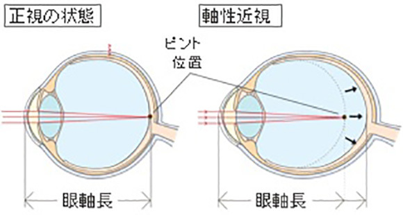 近視の進行